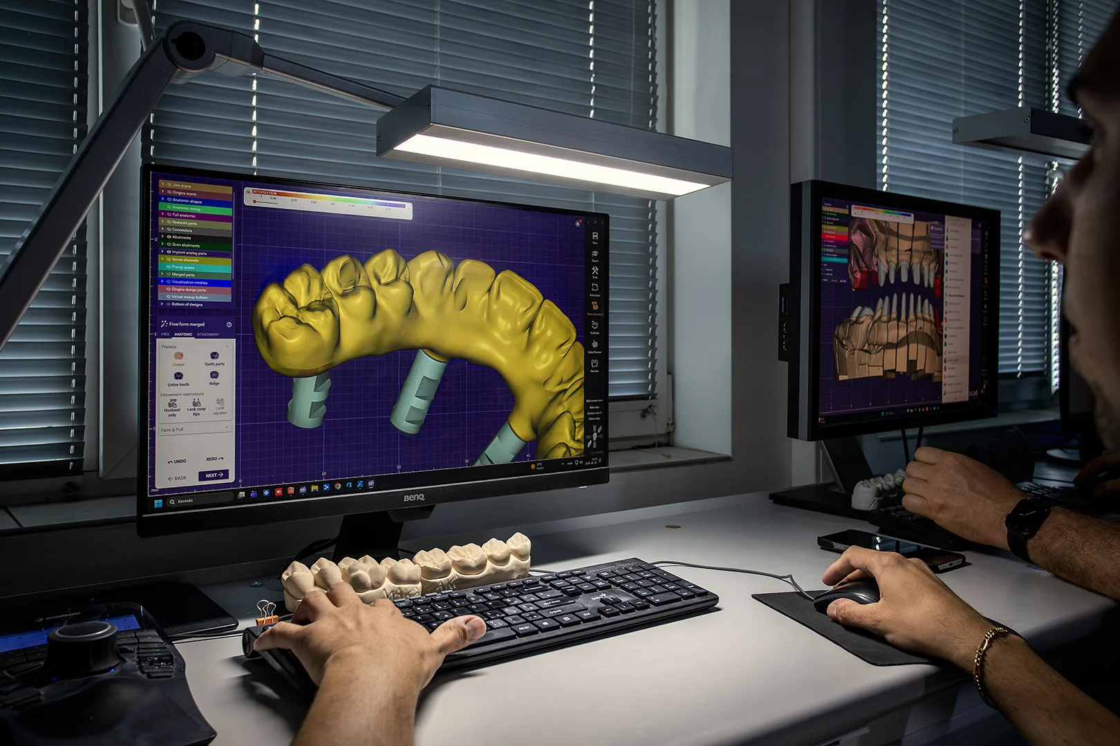 Digitale Konstruktion einer All-on-X-Restauration am Monitor